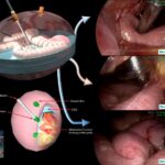 tecnica LE-HIPEC per la carcinosi peritoneale, the laparoscopy enhanced hipec technique