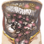 carcinosi peritoneale, peritoneal carcinomatosis