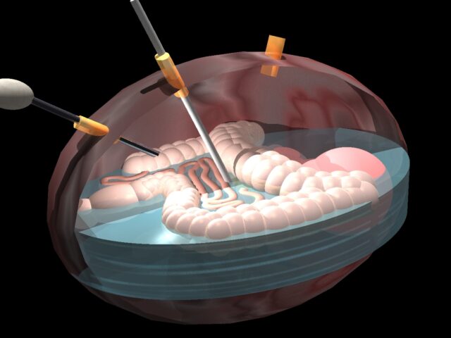 laparoscopy enhanced hipec 3d