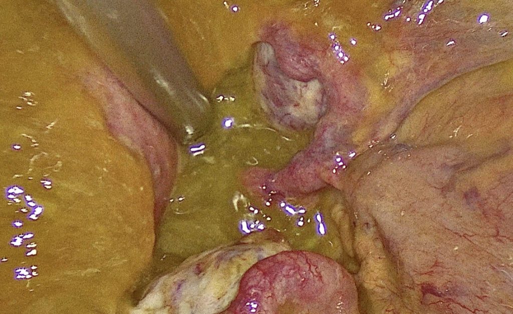 Pseudomixoma Peritonei pelvico in laparoscopia